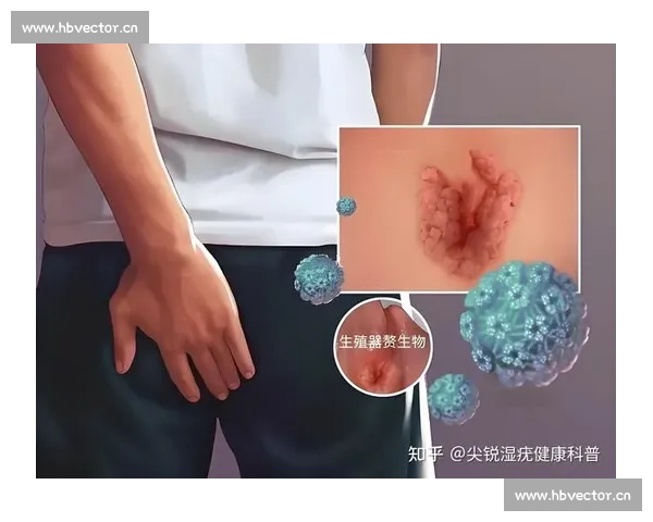 深入解析尖锐湿疣的传播途径预防措施及科学治疗新进展